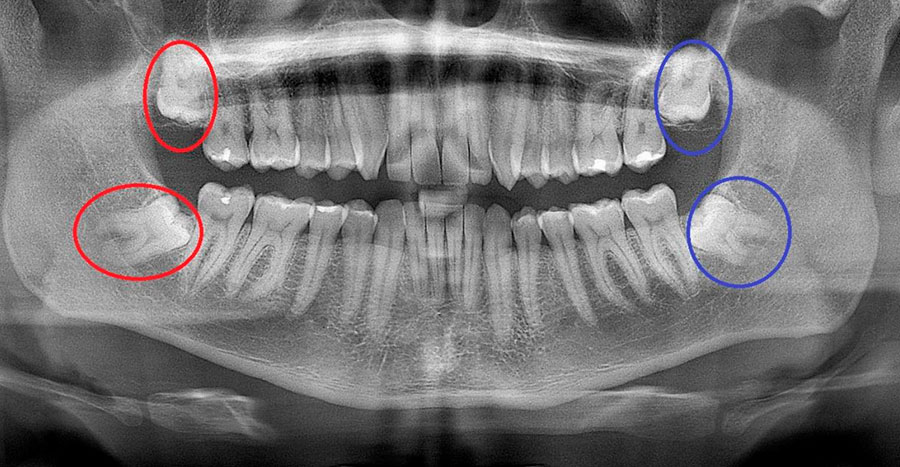 Cirurgia para remoção de dente do siso em São Paulo