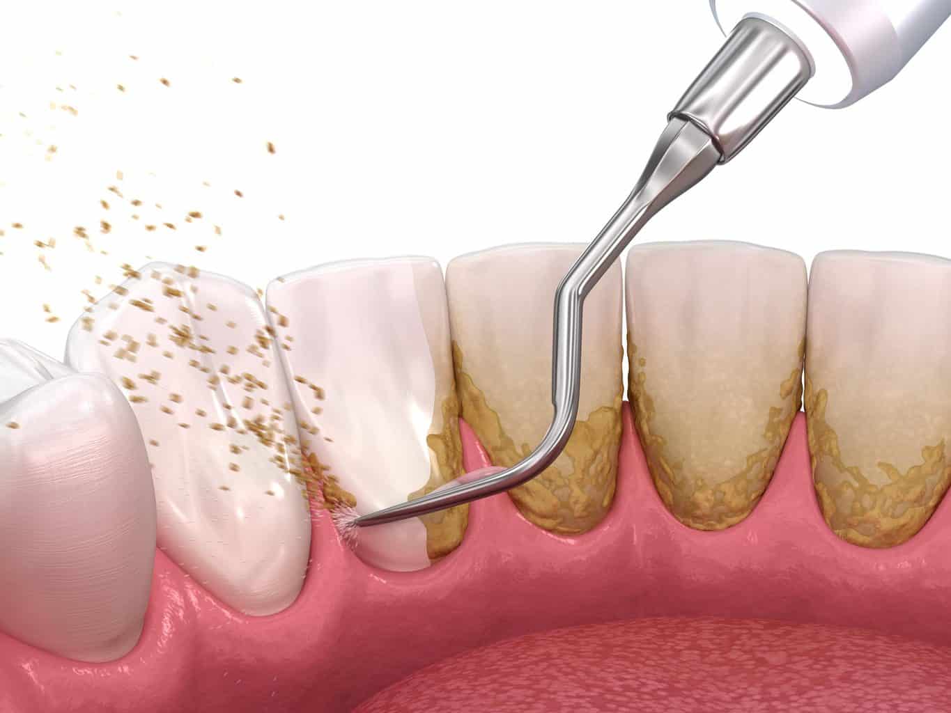 Remoção de cálculo dental com aparelho ultrassônico