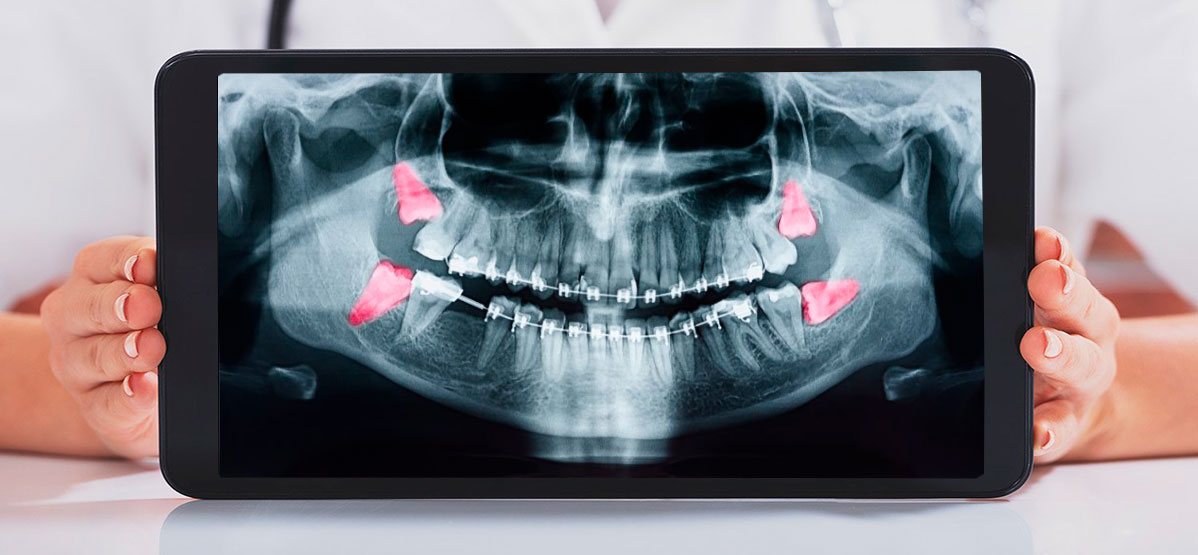 cirugia de extração do dente siso são paulo