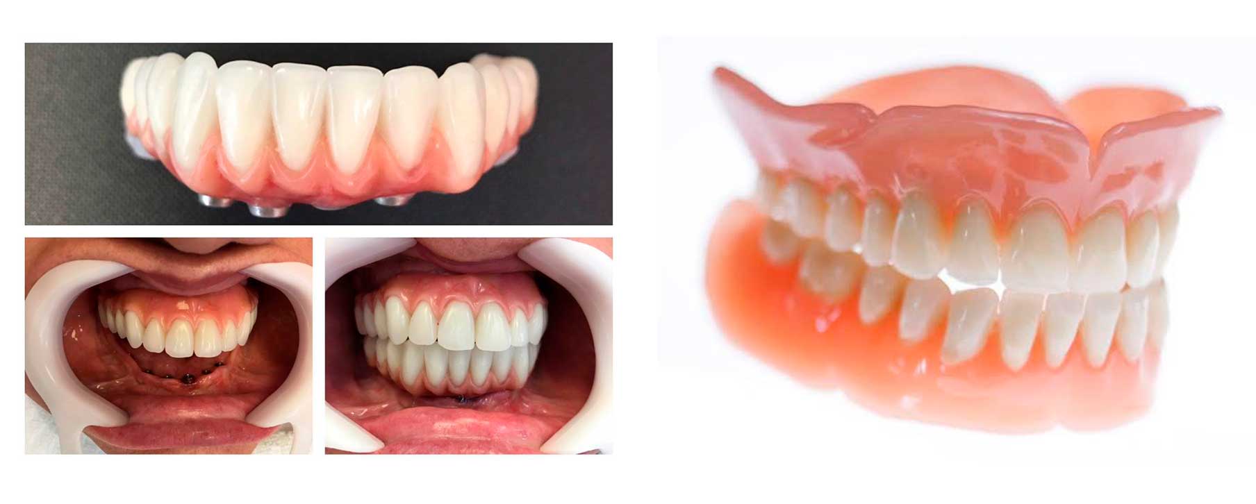 Comparação entre prótese dentária removível e prótese fixa sobre implantes